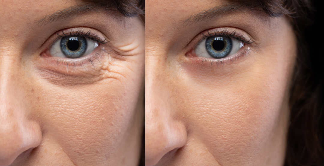 Close-up of before-and-after results of Botox, highlighting smoother skin and reduced wrinkles around the eye.