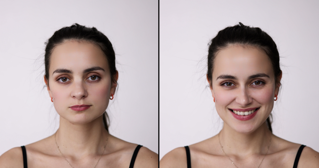 A before-and-after image showing the transformative effects of dermal fillers for enhancing facial volume and symmetry.