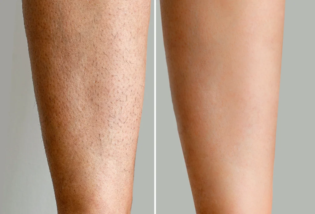 Close-up of a leg showing before and after laser hair removal results.